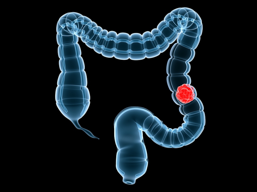 Is there a new test to take for colon cancer?