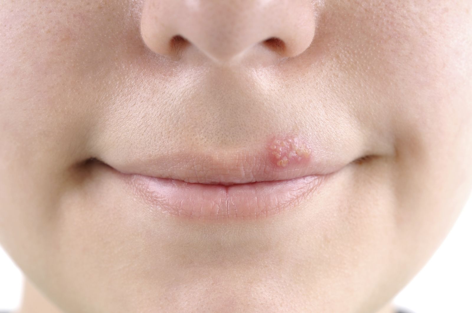 Cold sores - Harvard Health