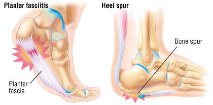 sharp pain on side of heel