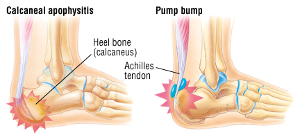 tendon above heel hurts