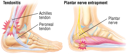 acute pain in heel of foot