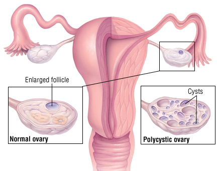 Polycystic Ovary Syndrome Harvard Health