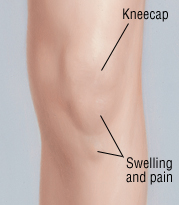 tenderness under knee cap