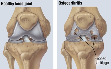 osteoarthritis harvard health