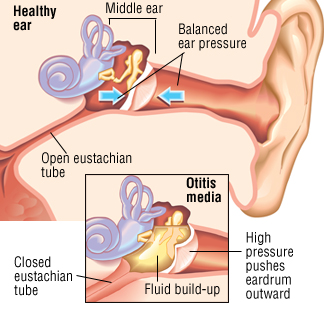 Can You Put Alcohol In Your Ear To Dry Up Fluid Middle Ear Infection Otitis Media Harvard Health
