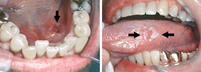 kanker lidah carcinoma squamous mulut mengancam perokok bahaya inilah sariawan