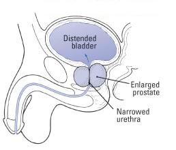 how to reduce prostate enlargement naturally