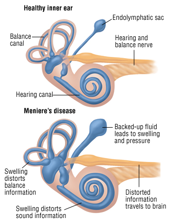 Meniere&#39;s Disease - Harvard Health