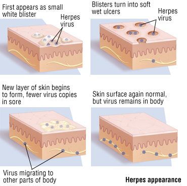 signs of herpes on penis