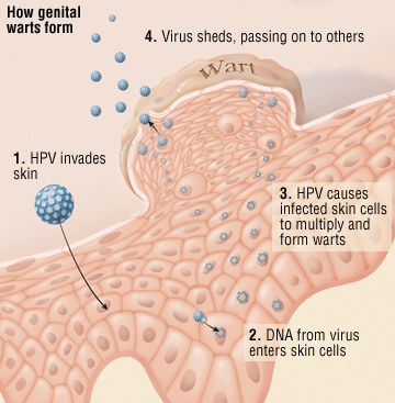 Human papillomavirus causes and effects - Papillomavirus symptoms in humans