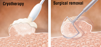 hpv surgical removal