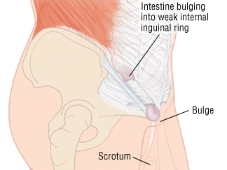 Image result for inguinal hernia