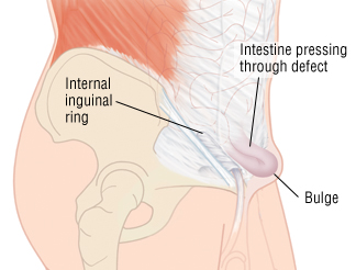 Hernia Recovery Chart