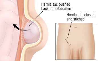 Hernia Recovery Chart