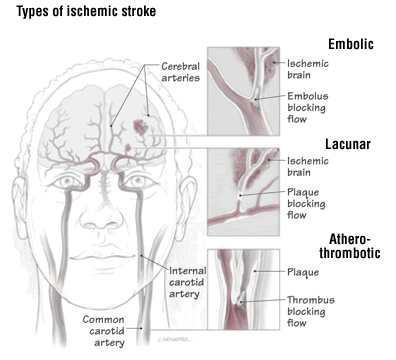 Lacunar Stroke Harvard Health