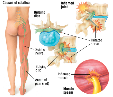 Sciatica - Harvard Health