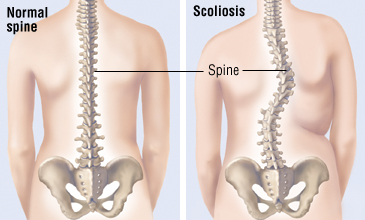 Scoliosis Harvard Health