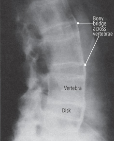 Food Diet Chart For Ankylosing Spondylitis