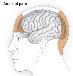 Tension Headache Harvard Health