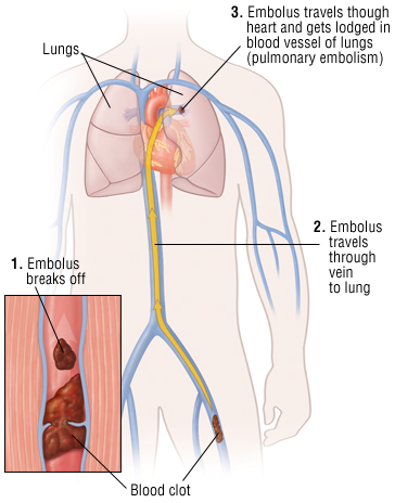 Diet Chart For Dvt Patients