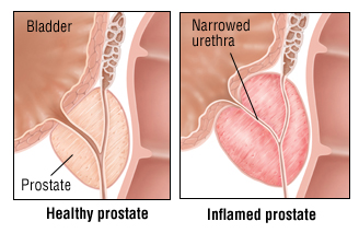 Chronic Prostatitis - Harvard Health