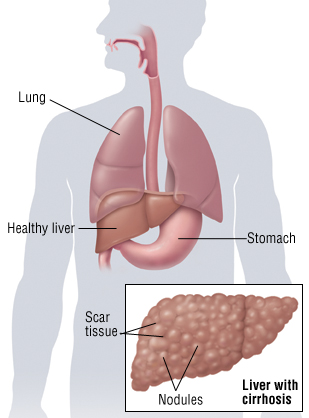 cirrhosis harvard health