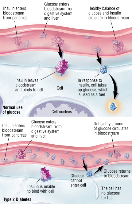 Difference Between Type 1 And 2 Diabetes Chart