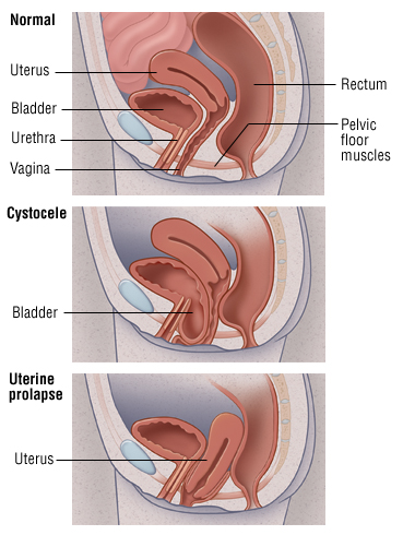 Uterine And Bladder Prolapse Harvard Health