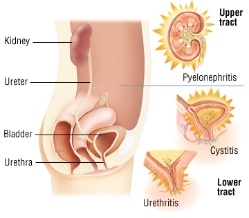 Urinary Tract Infection in Women - Harvard Health