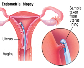 Dysfunctional Uterine Bleeding Harvard Health