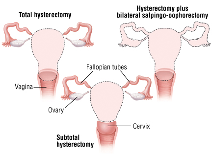 Image result for image of hysterectomy