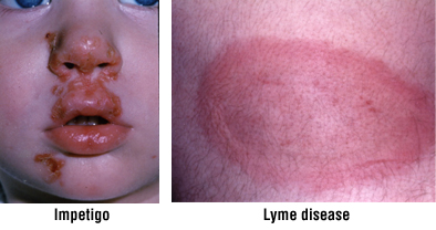 Rash Harvard Health
