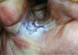 Athlete's Foot (Tinea Pedis) - Harvard 