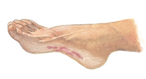 Athlete's Foot (Tinea Pedis) - Harvard 