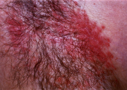 candida cause
