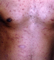 Pityriasis Rosea Harvard Health