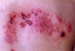 Treatment Of Herpes Zoster In Hiv Patients