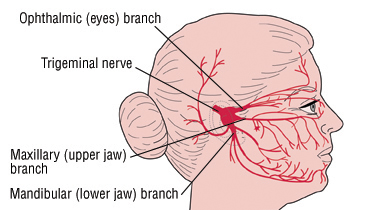 Sinus headache and the trigeminal nerve showing where pain may be felt.