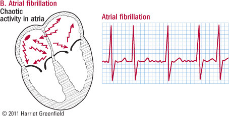illustration of heart in atrial fibrillation and ECG showing irregular pattern