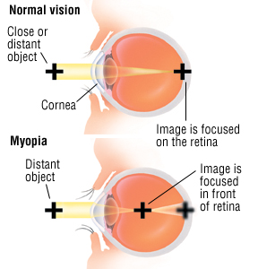 Myopia Snellen Chart