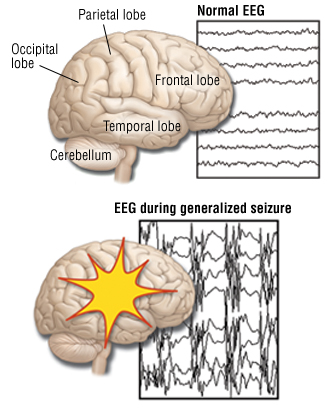 Generalized Seizures (Grand Mal Seizures) - Harvard Health Generalized Seizures (Grand Mal Seizures) - Harvard Health