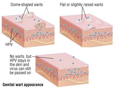 removal hpv genital warts