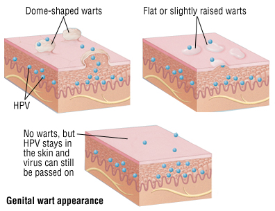 hpv warts prognosis vindeca viermele ouălor