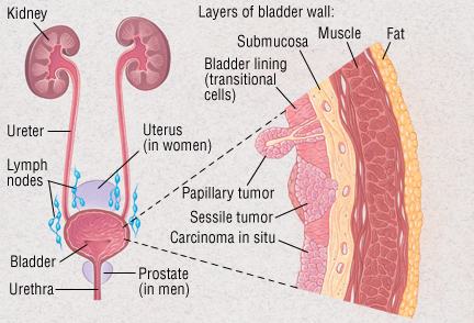 Metastatic cancer in bladder. Bladder Cancer