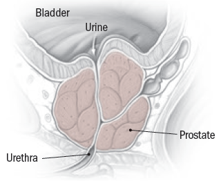 how to reduce prostate enlargement naturally