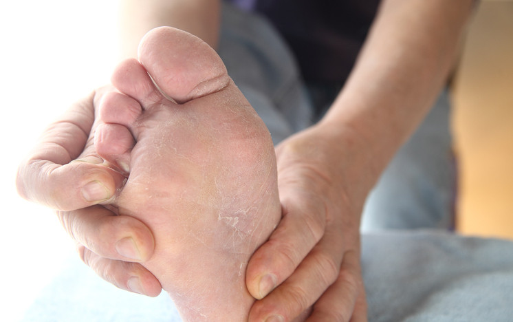 foot: Causes, prevention, and treatment 