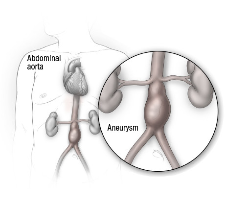 Checking For An Abdominal Aortic Aneurysm Who When And Why