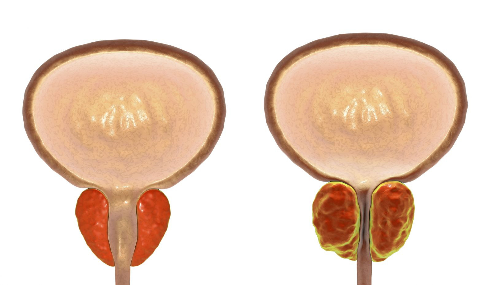 An enlarged prostate gland and incontinence