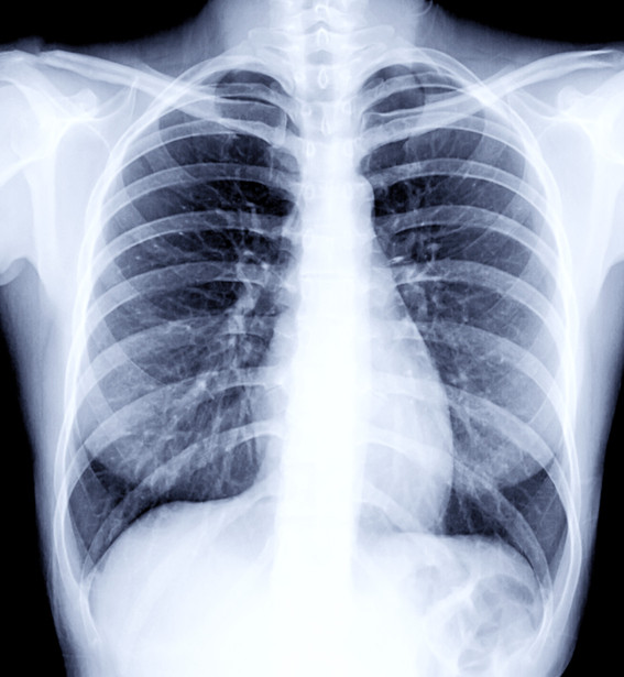X Rays Harvard Health