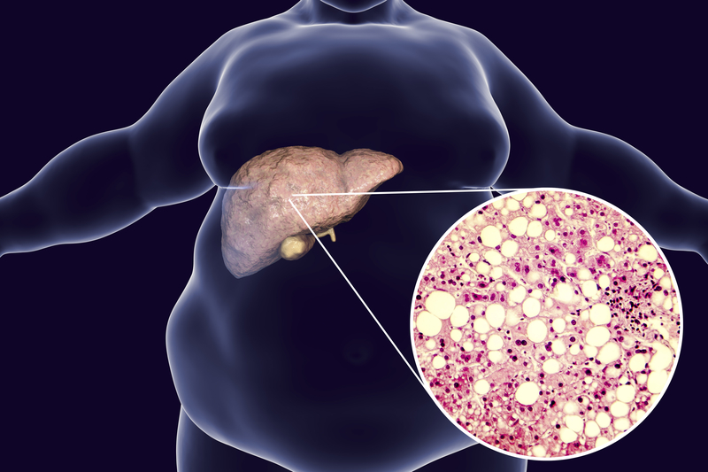 Non-Alcoholic Fatty Liver Disease